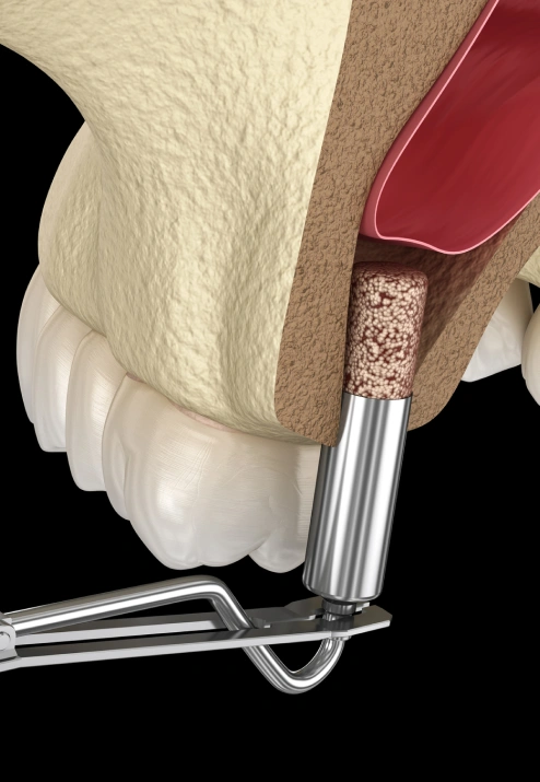 Advanced bone and sinus grafting at Bespoke Dental Newnan in Newnan, GA, helping rebuild bone density for long-term dental implant success.