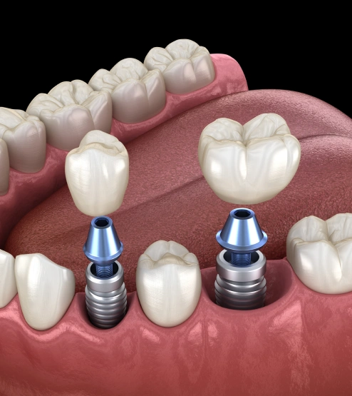 Dental implant placement at Bespoke Dental Newnan in Newnan, GA, restoring missing teeth with a strong, natural-looking solution.