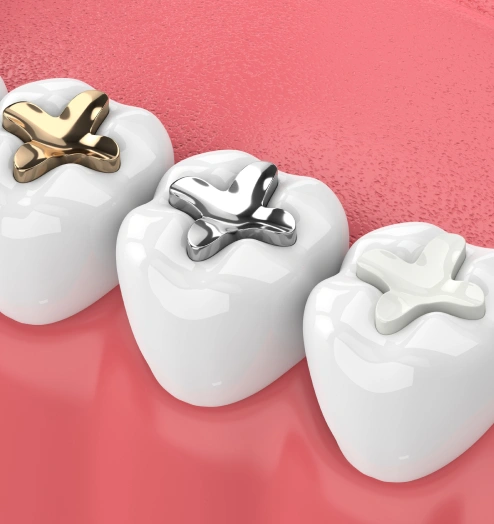 Tooth-colored fillings at Bespoke Dental Newnan in Newnan, GA, restoring a cavity with natural-looking composite material that blends seamlessly with surrounding teeth for a healthy, discreet smile.